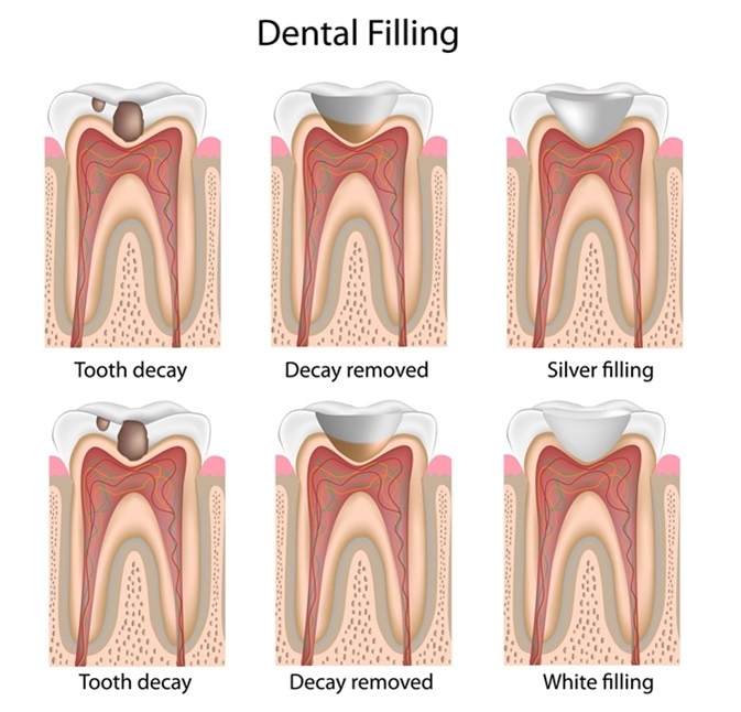 Dental fillings. Image Credit: Alila Medical Media / Shutterstock
